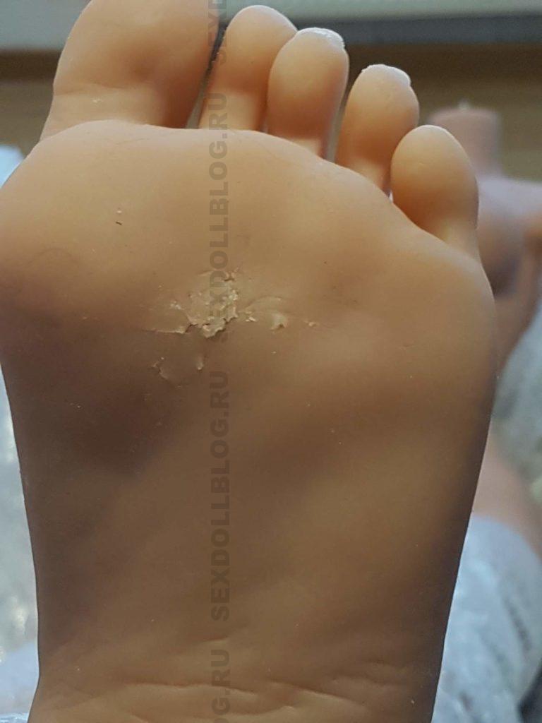 Повреждения ступни 01